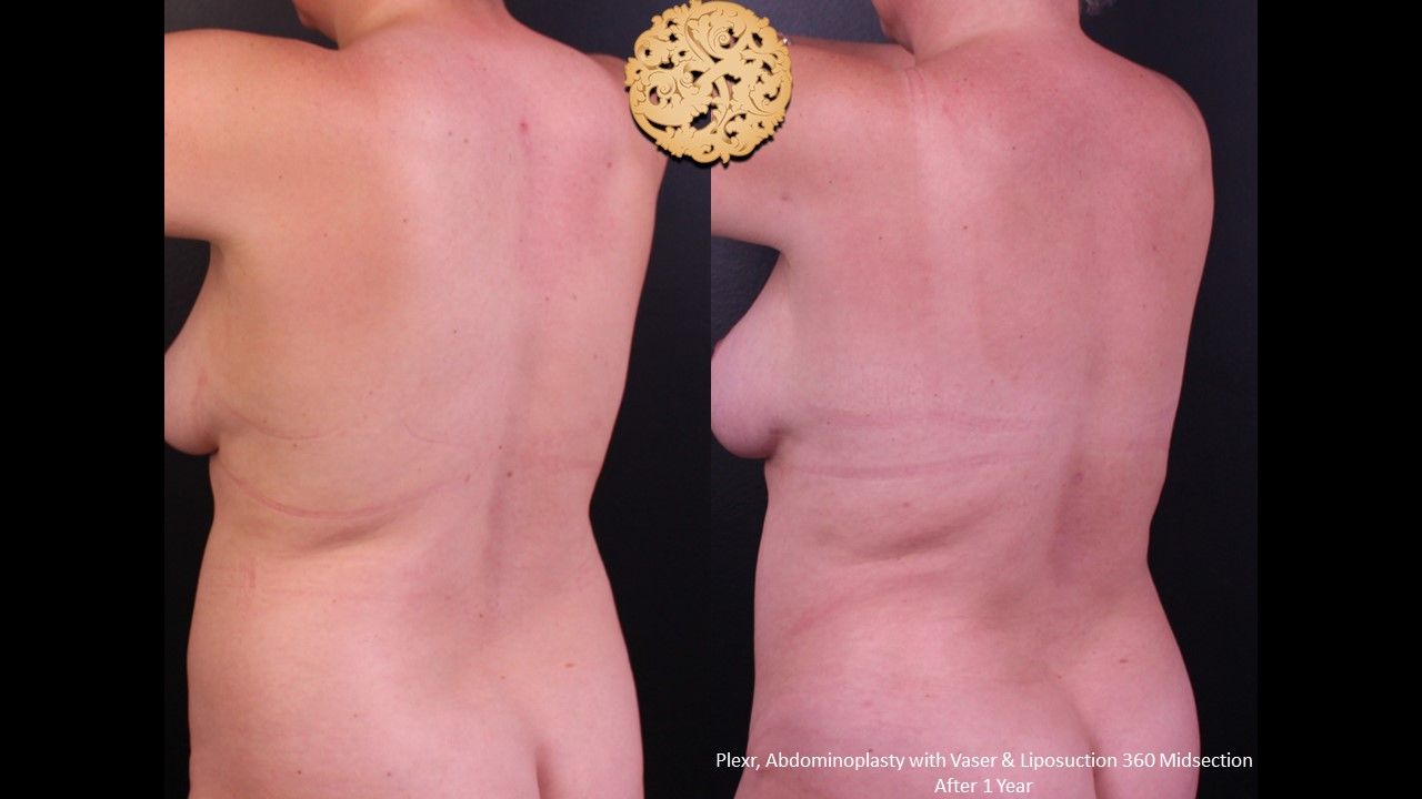 Plexr Before & After