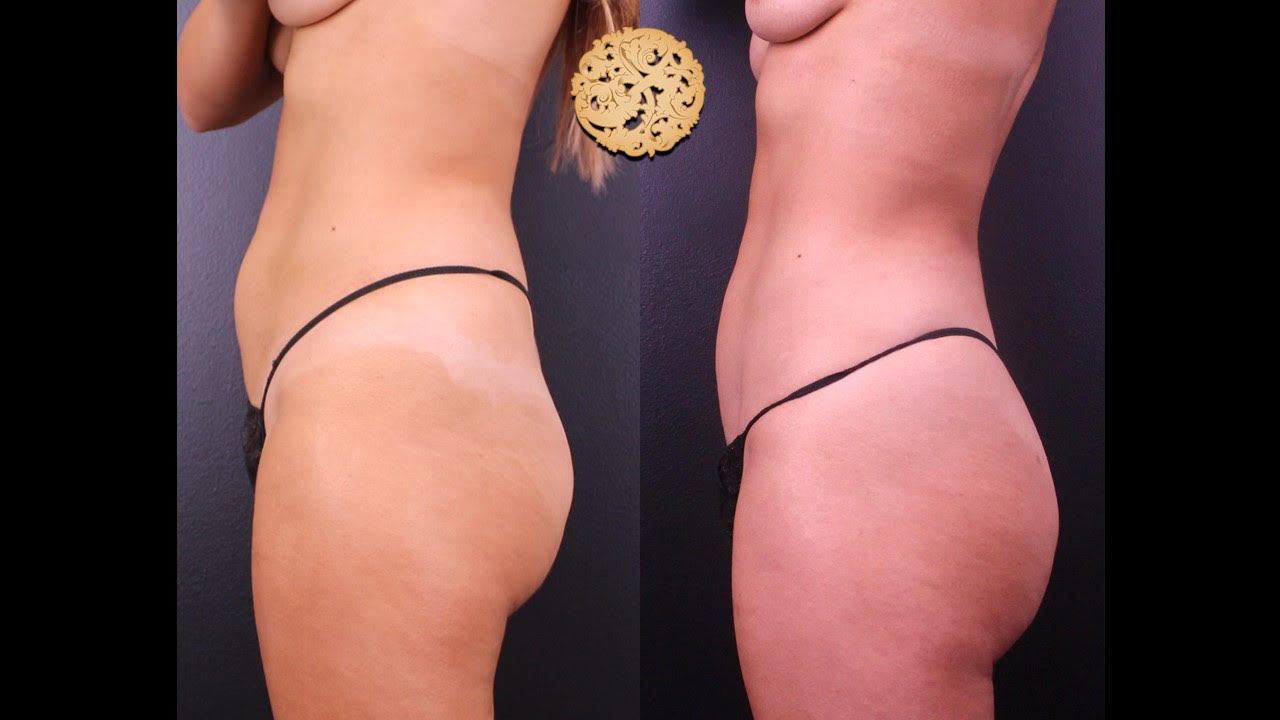 Abs Liposuction Before & After