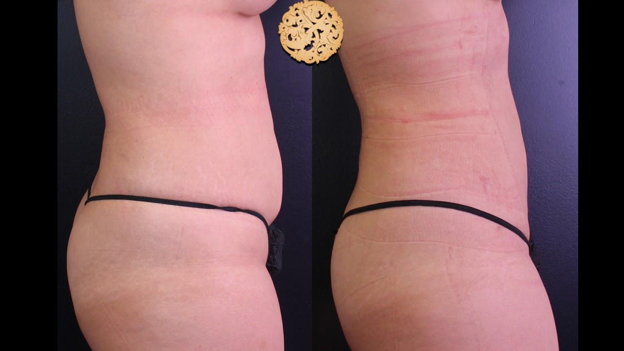Abs Liposuction Before & After
