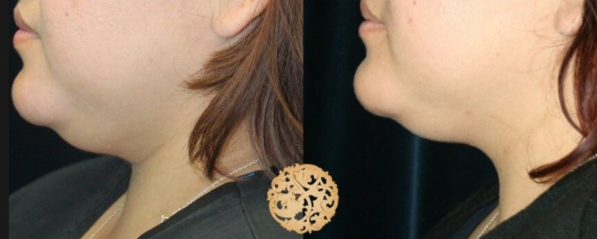 Chin Coolsculpting Before & After