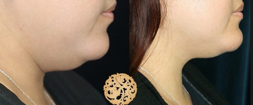 Chin Coolsculpting Before & After