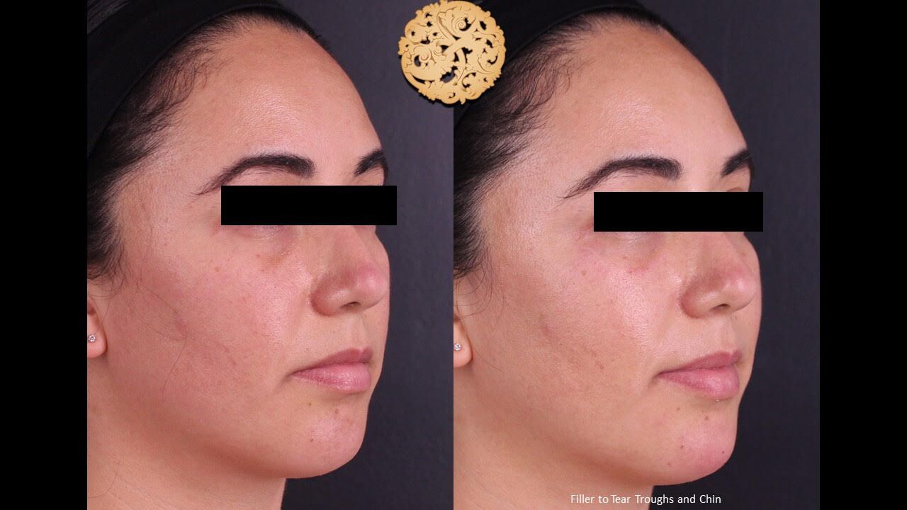 Tear Troughs Before & After