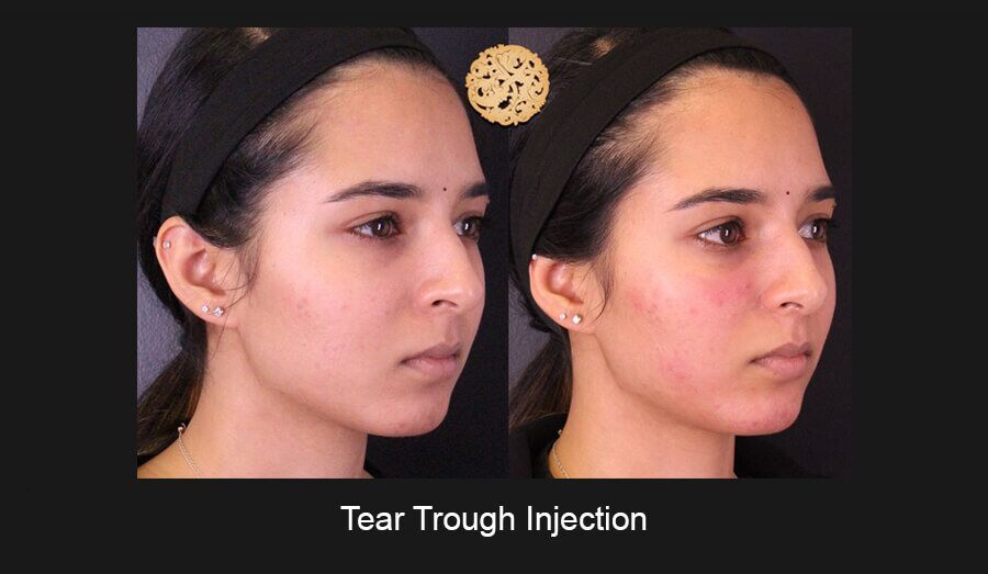 Tear Troughs Before & After