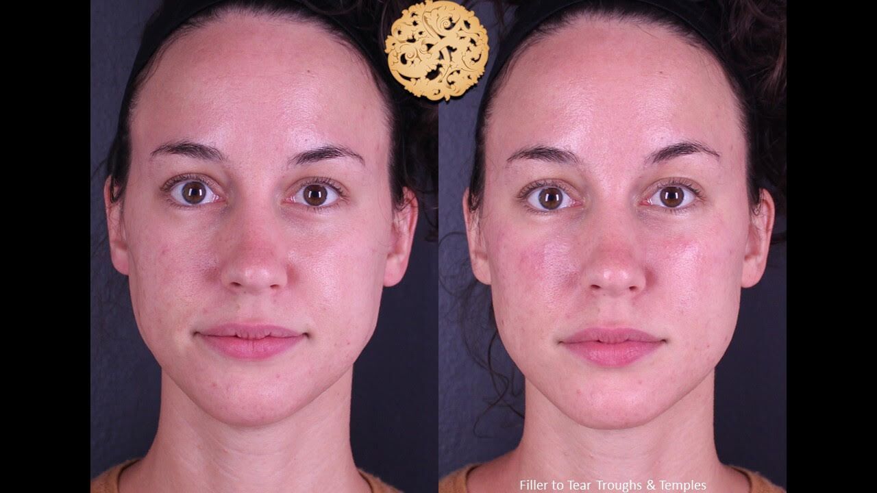 Tear Troughs Before & After