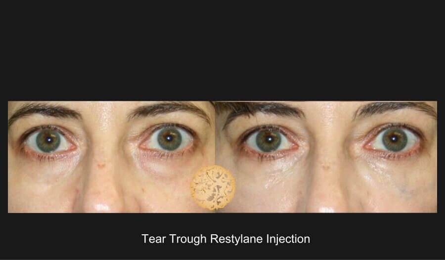 Tear Troughs Before & After