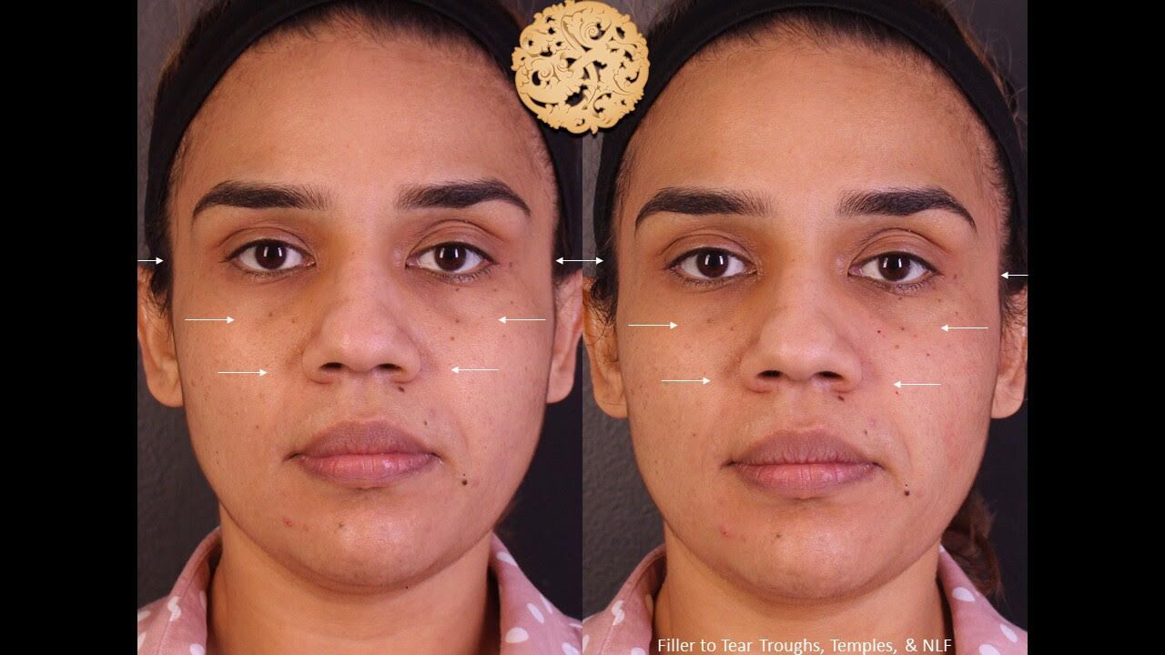 Tear Troughs Before & After