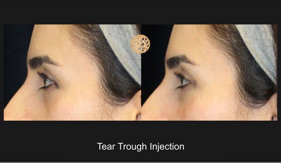 Tear Troughs Before & After