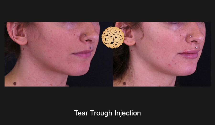 Tear Troughs Before & After