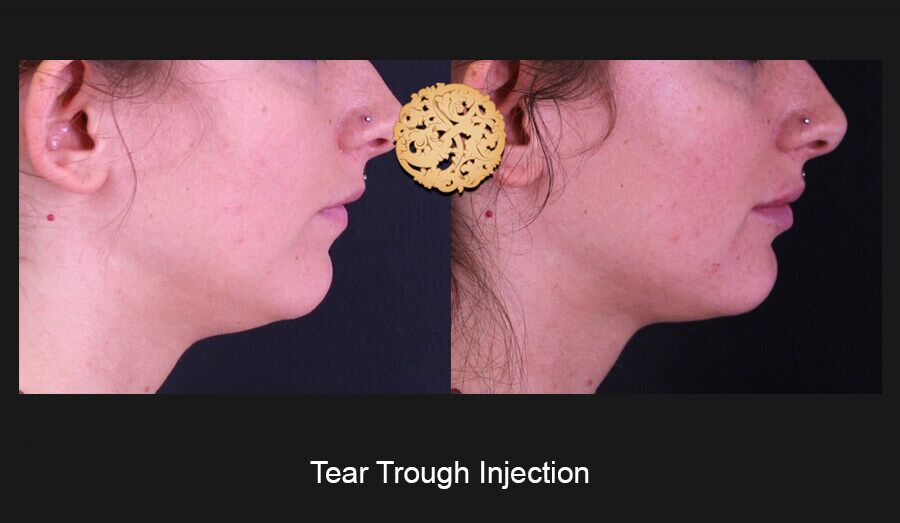 Tear Troughs Before & After