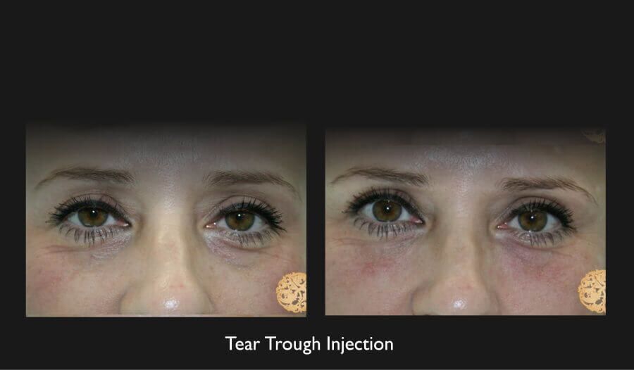 Tear Troughs Before & After