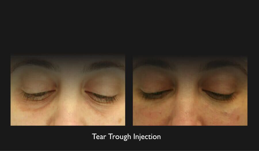 Tear Troughs Before & After