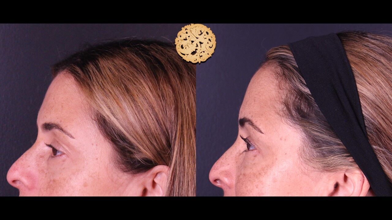 Tear Troughs Before & After