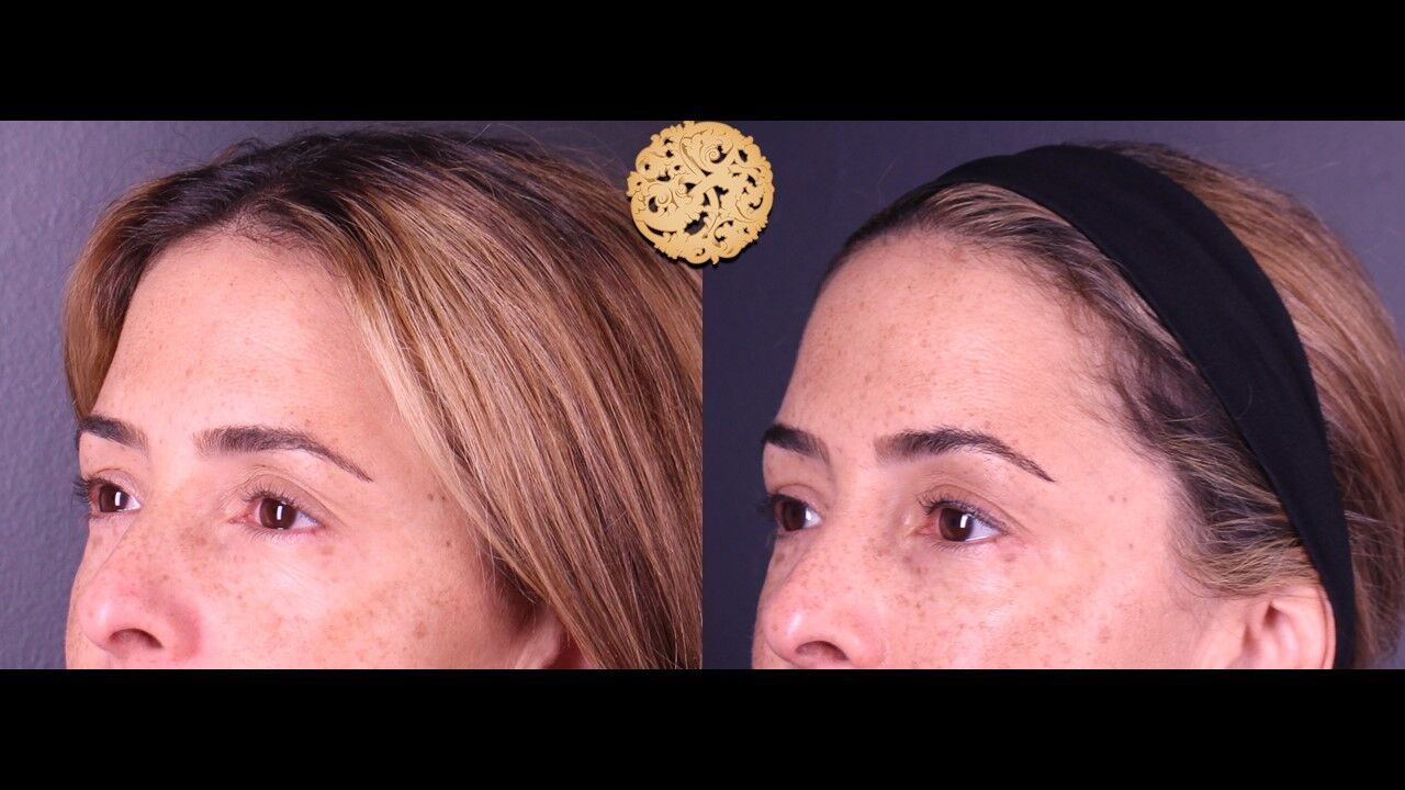 Tear Troughs Before & After