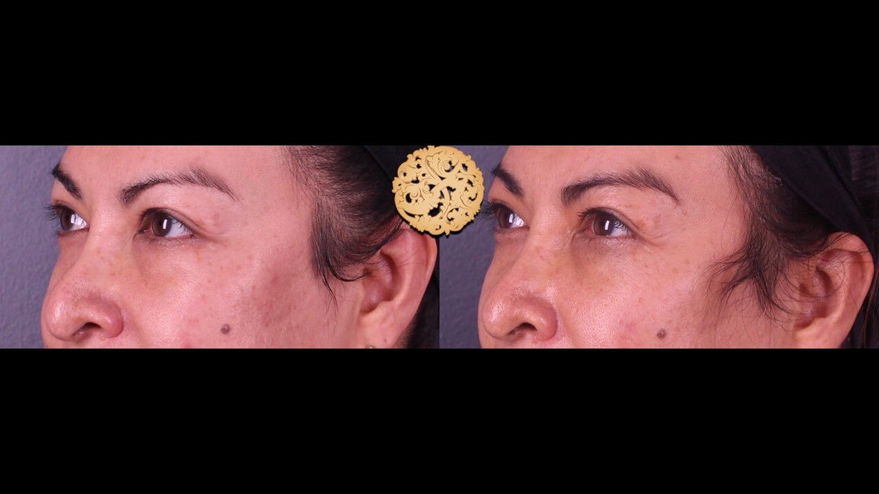 Tear Troughs Before & After