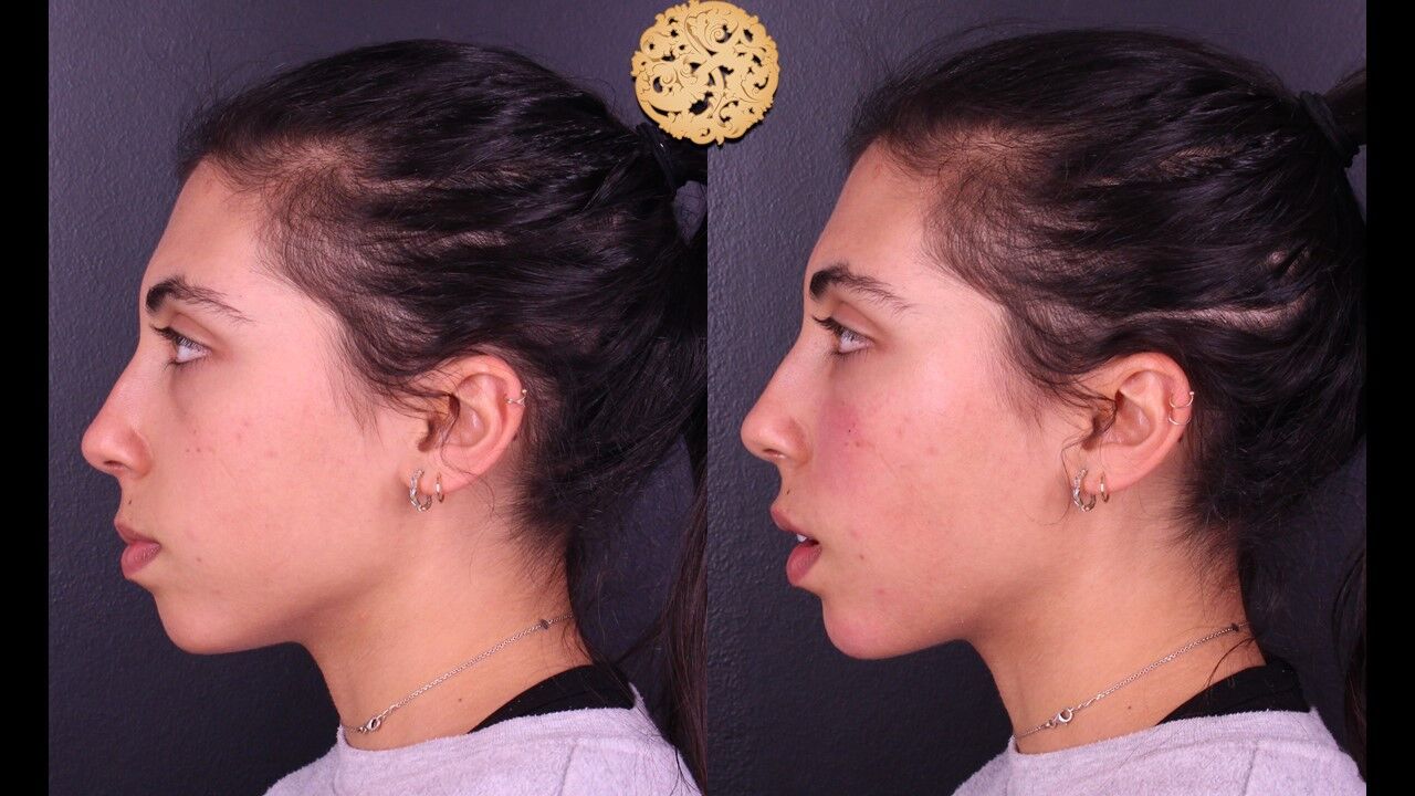 Tear Troughs Before & After