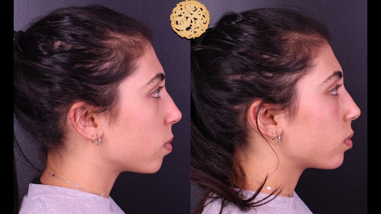 Tear Troughs Before & After