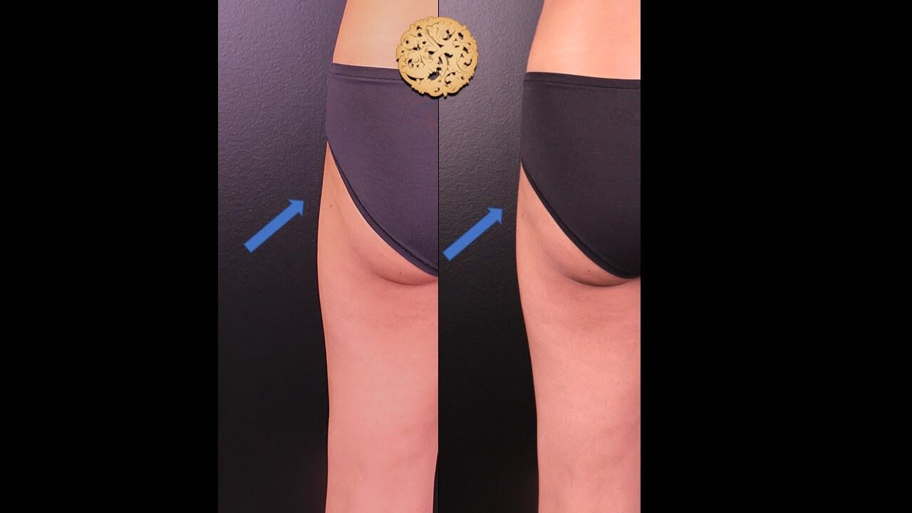 Renuva Before & After