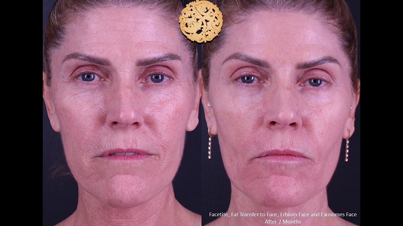 Before and after facial treatment comparison.