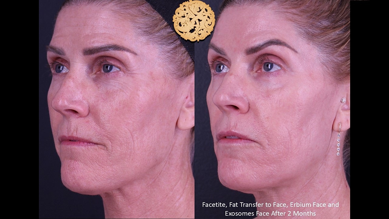Before and after facial rejuvenation treatments comparison.