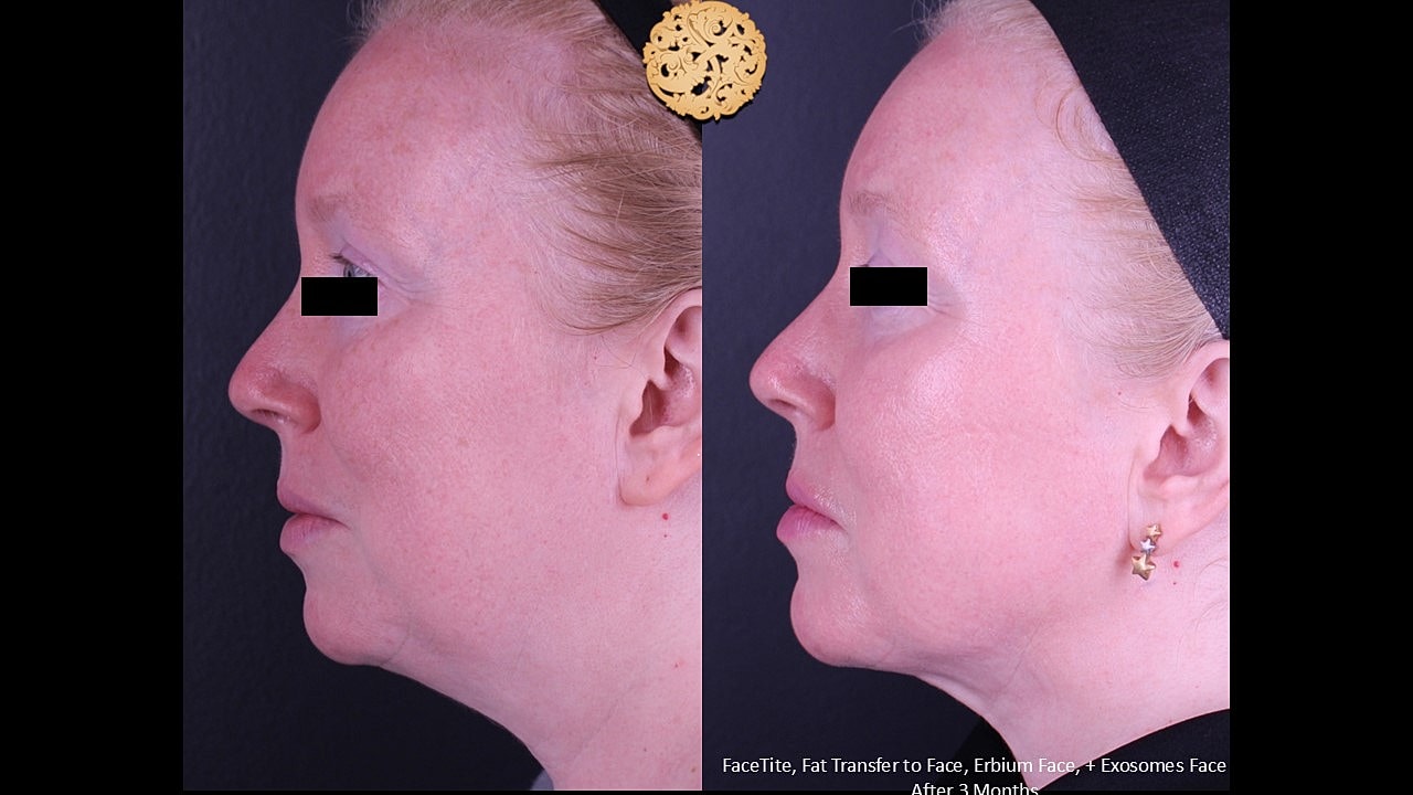 Before and after facial aesthetic treatment comparison.