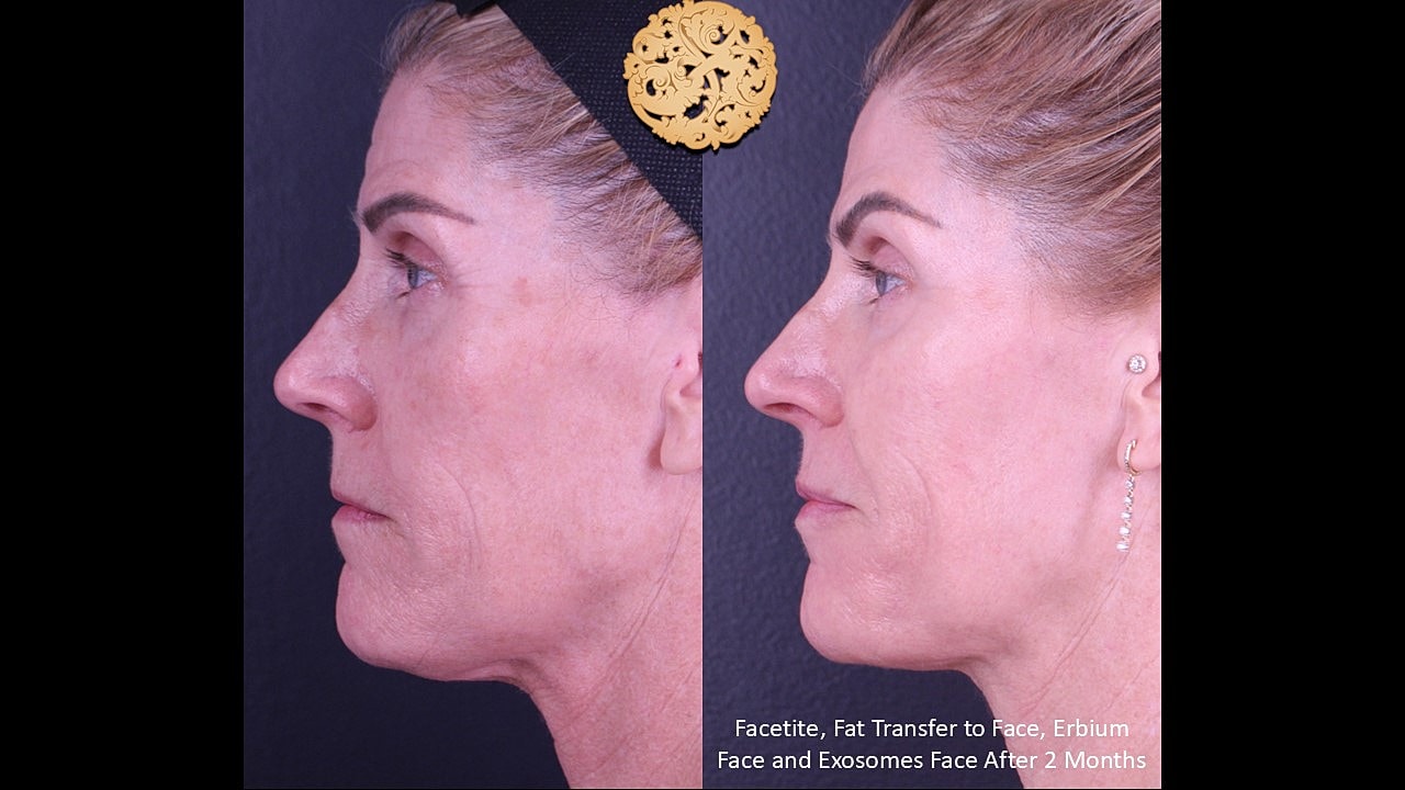 Before and after facial rejuvenation treatment comparison.