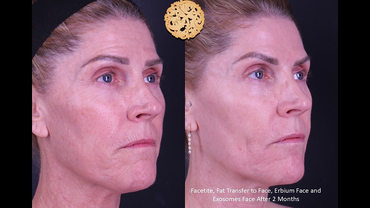 Before and after facial rejuvenation treatment results.