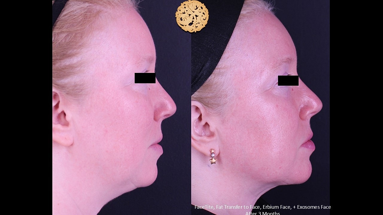Before and after facial aesthetic treatments comparison.