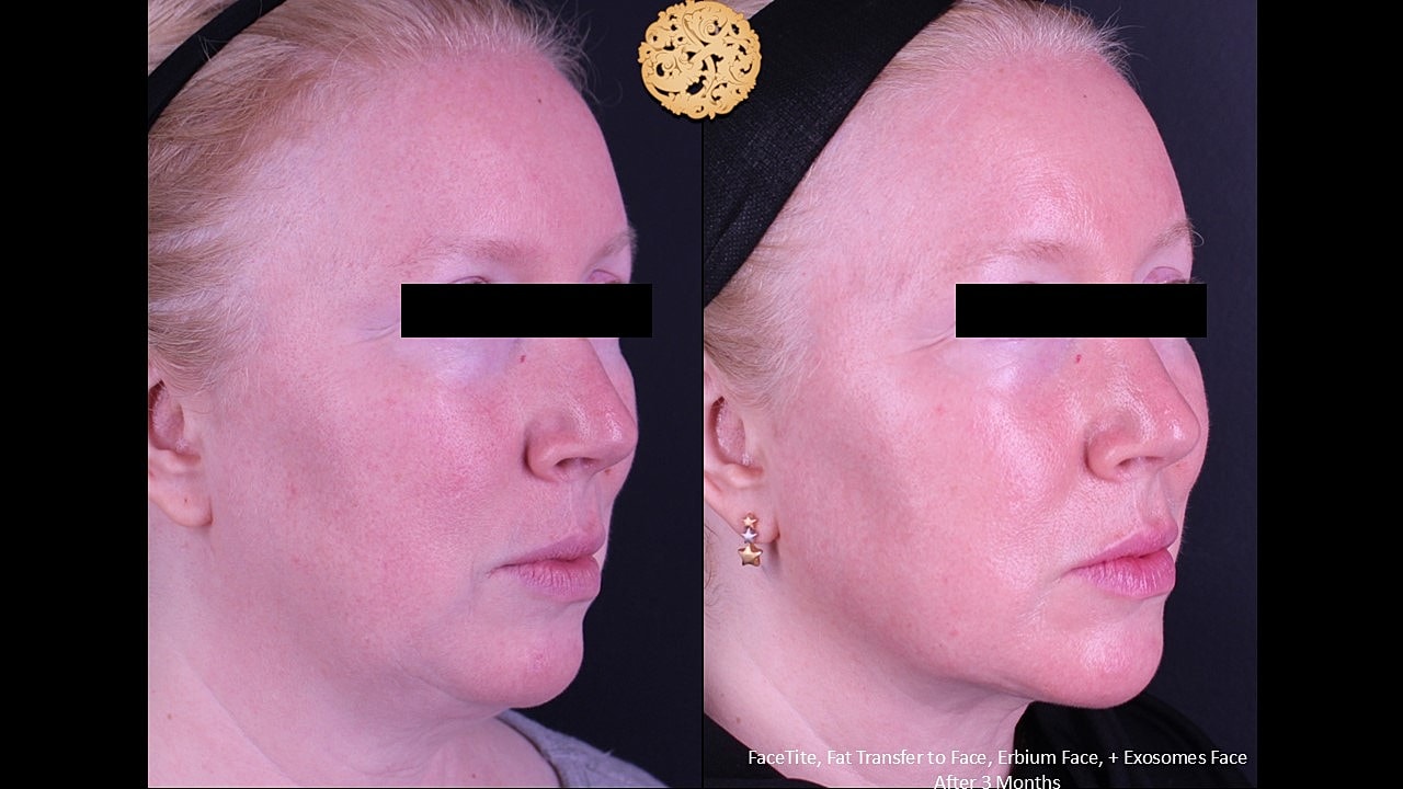 Before and after facial aesthetic treatment results.